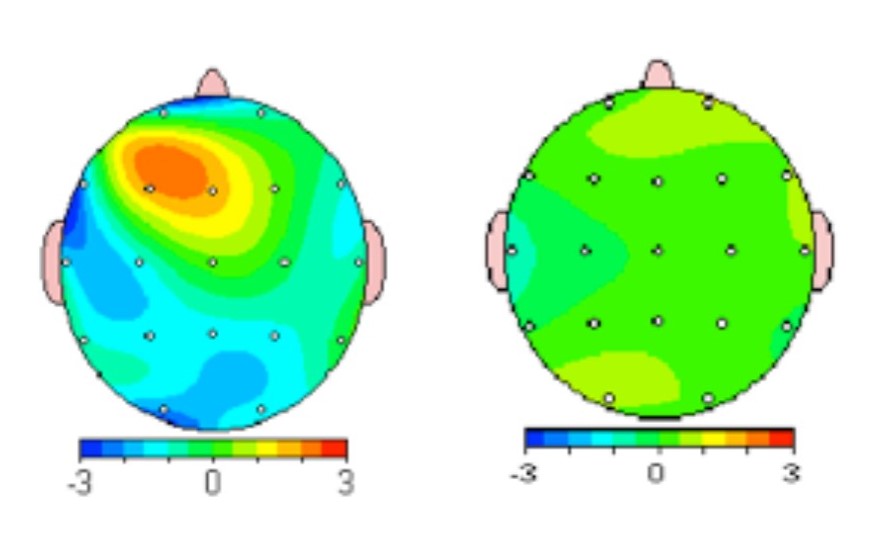 depresyon tedavisi nasıl olur